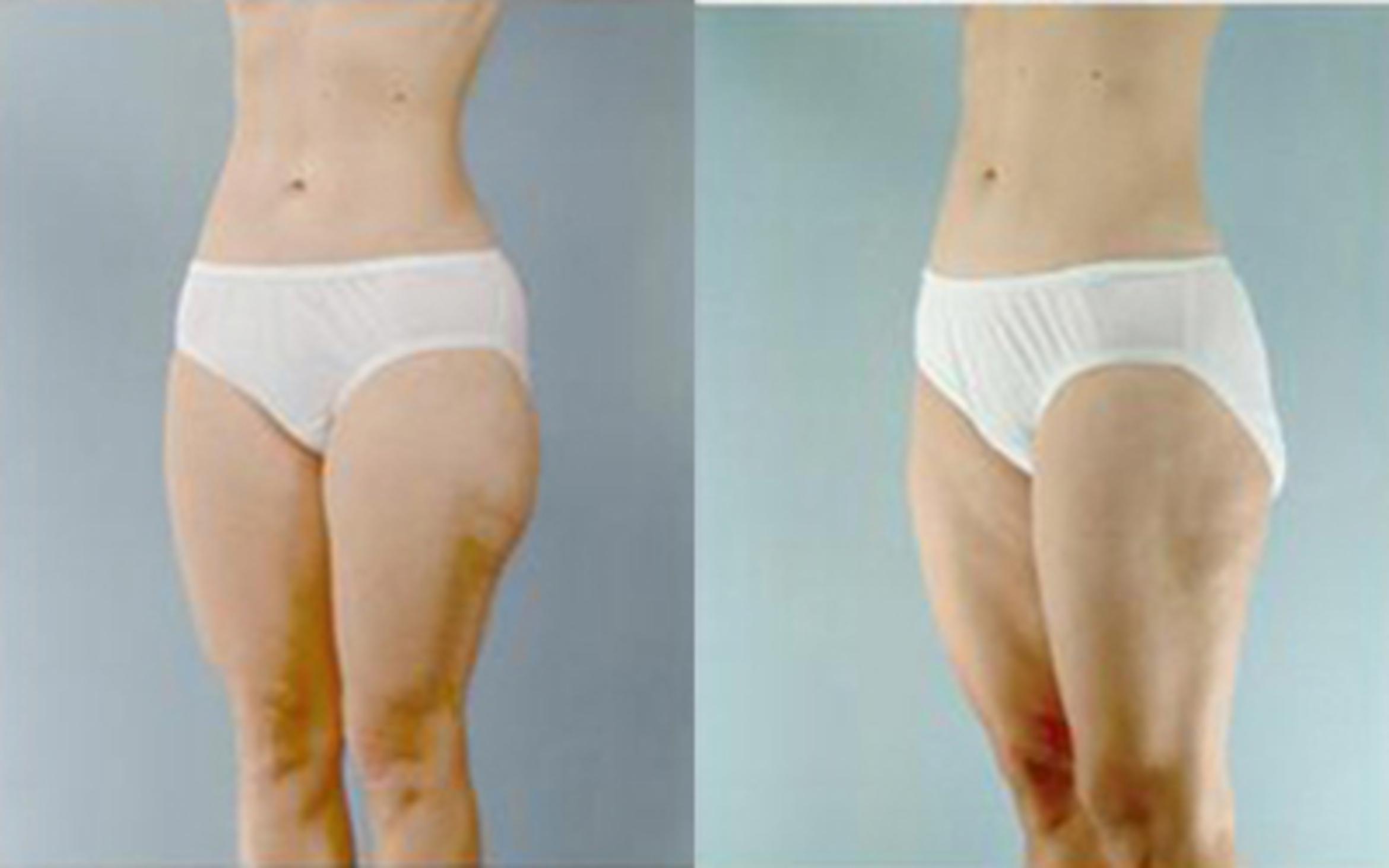 Before & After Liposuction Case 4055 View 2 View in Houston, TX