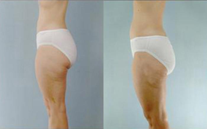 Before & After Liposuction Case 4055 View 3 View in Houston, TX