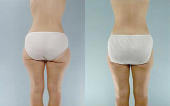 Before & After Liposuction Case 4055 View 4 View in Houston, TX