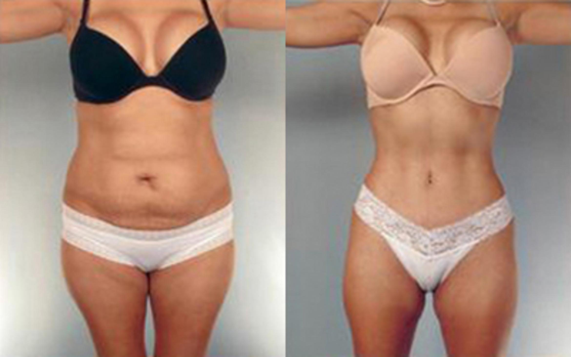 Before & After Liposuction Case 4065 View 1 View in Houston, TX
