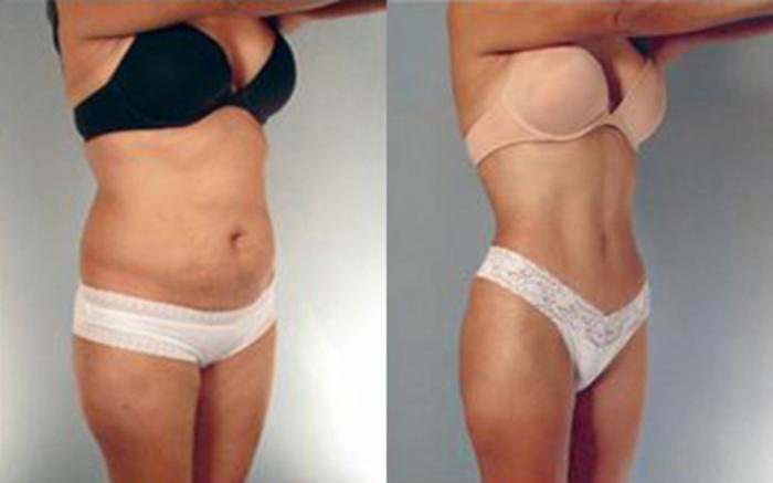 Before & After Liposuction Case 4065 View 2 View in Houston, TX