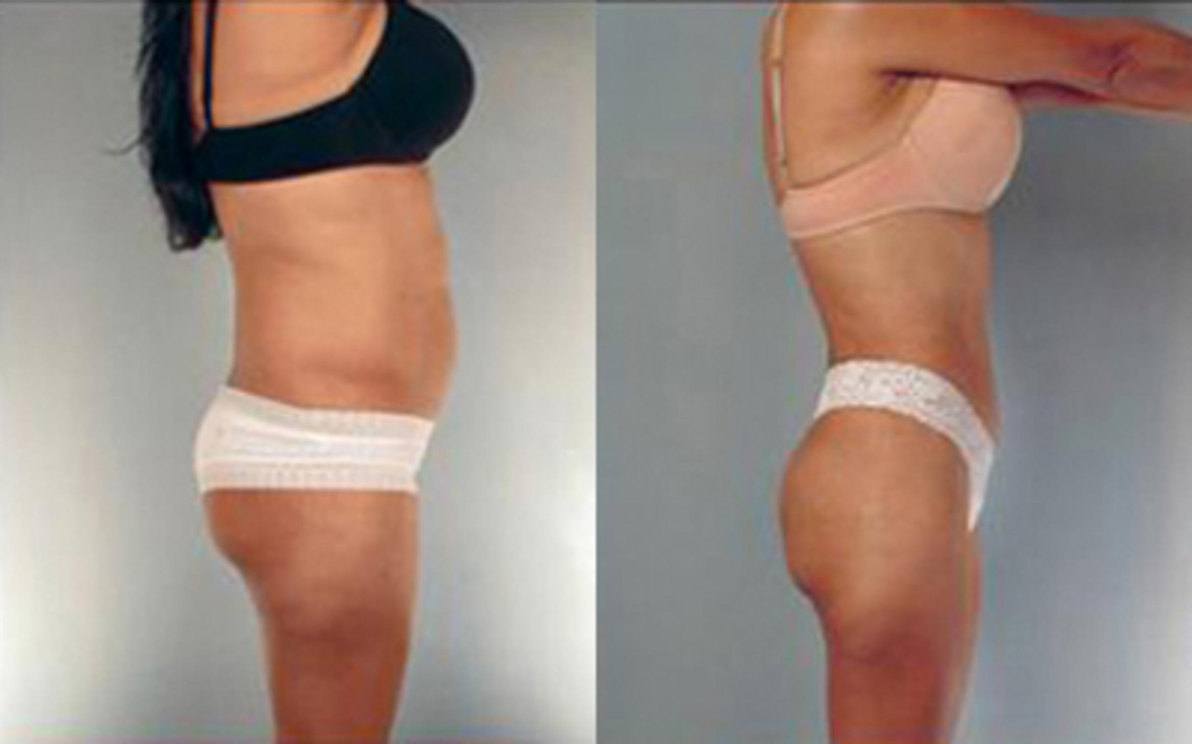 Before & After Liposuction Case 4065 View 3 View in Houston, TX