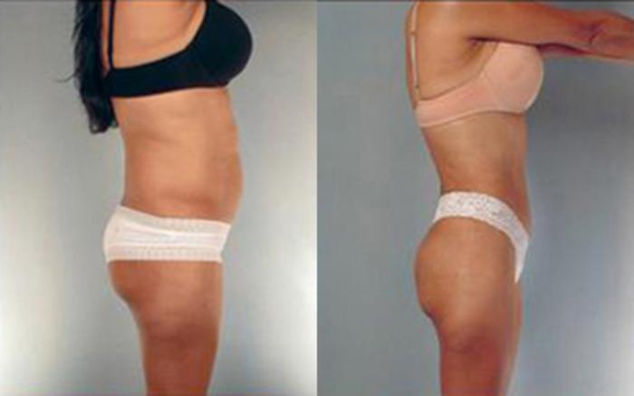 Before & After Liposuction Case 4065 View 3 View in Houston, TX