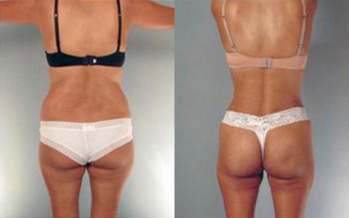 Before & After Liposuction Case 4065 View 4 View in Houston, TX