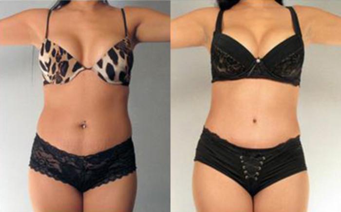 Before & After Liposuction Case 4075 View 1 View in Houston, TX