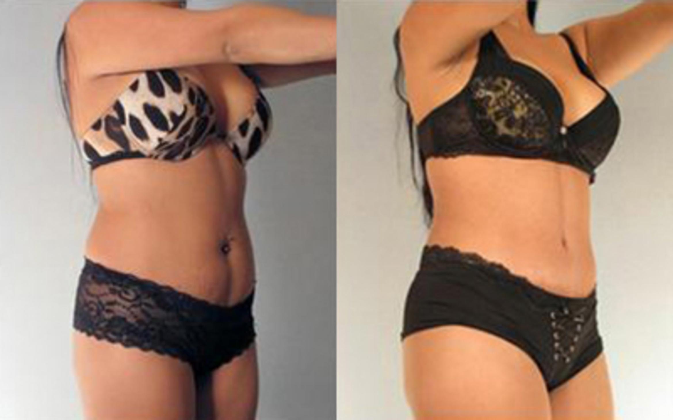 Before & After Liposuction Case 4075 View 2 View in Houston, TX
