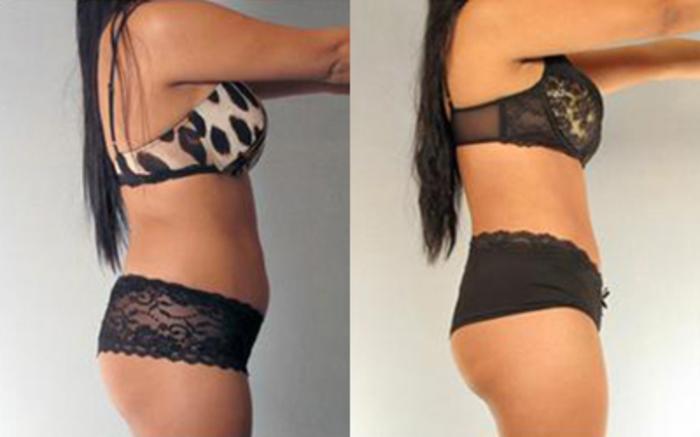 Before & After Liposuction Case 4075 View 3 View in Houston, TX