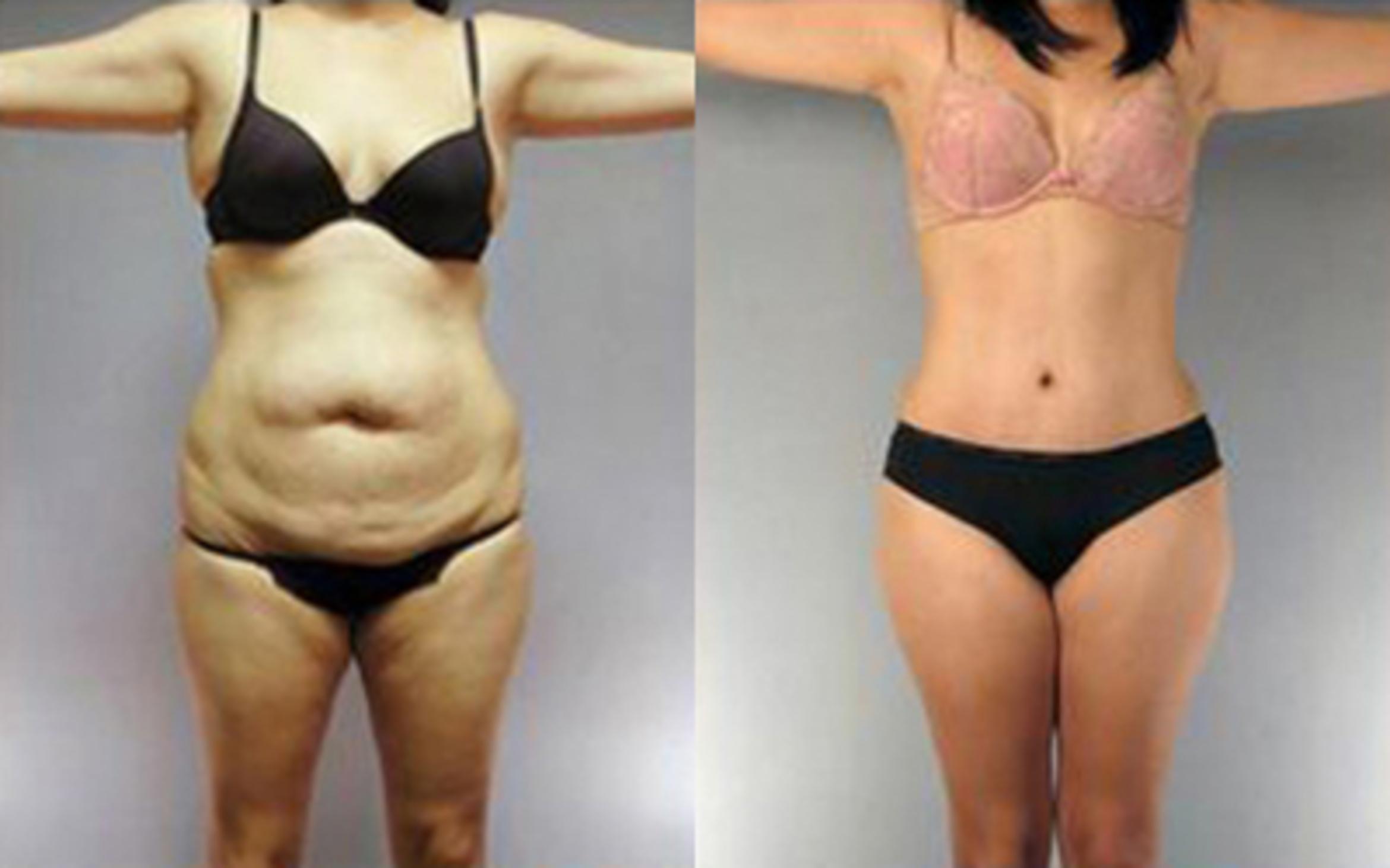 Before & After Liposuction Case 4083 View 1 View in Houston, TX