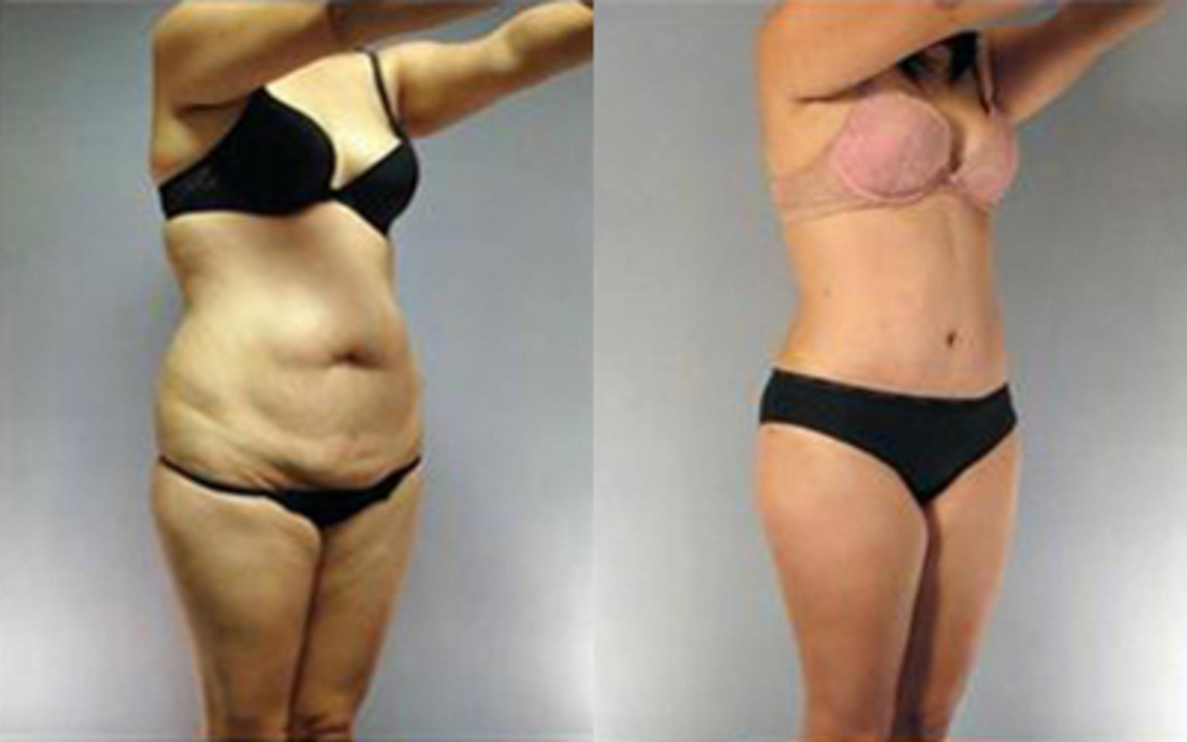 Before & After Liposuction Case 4083 View 2 View in Houston, TX