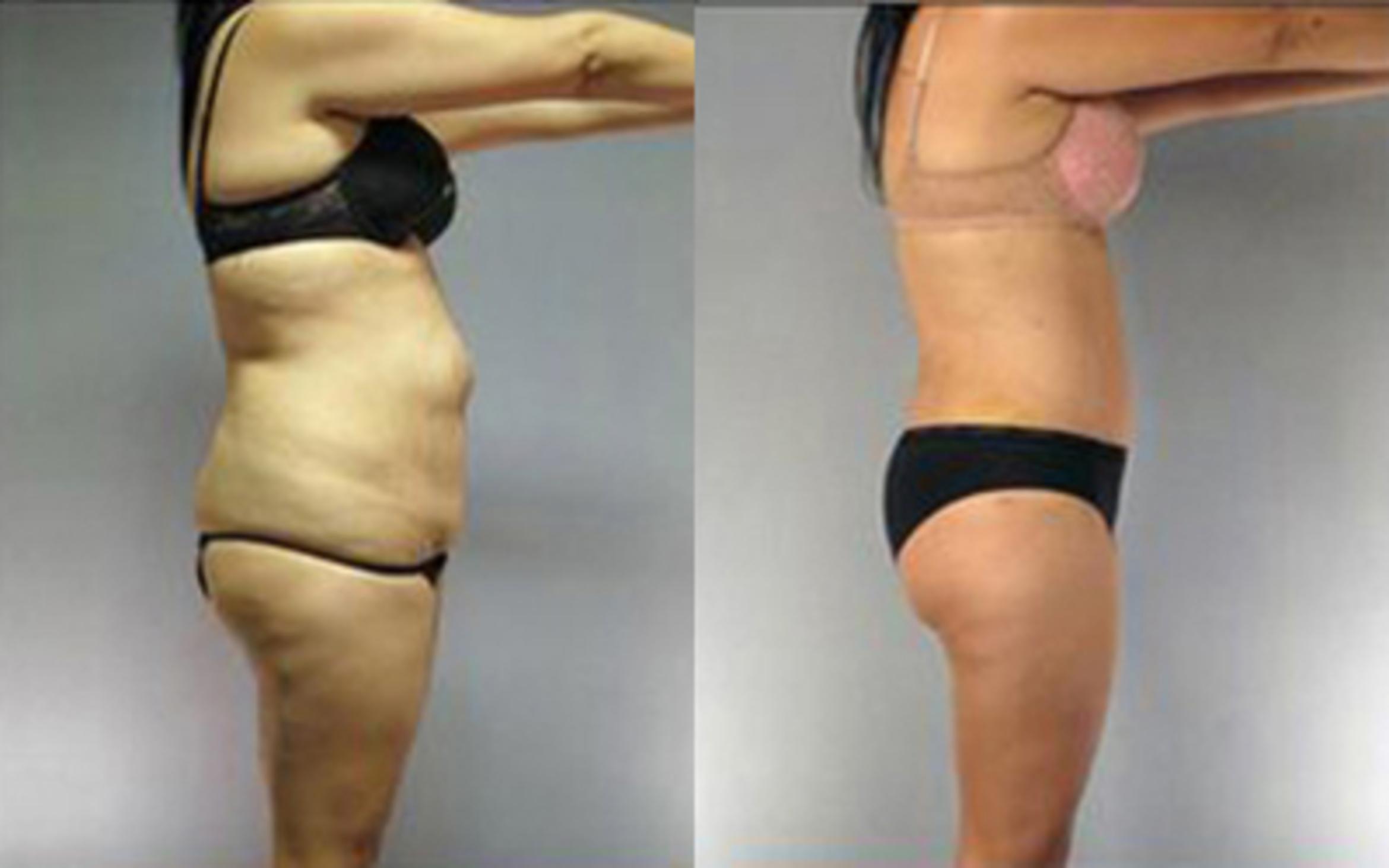 Before & After Liposuction Case 4083 View 3 View in Houston, TX