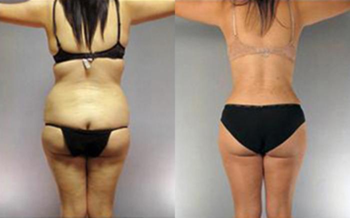 Before & After Liposuction Case 4083 View 4 View in Houston, TX