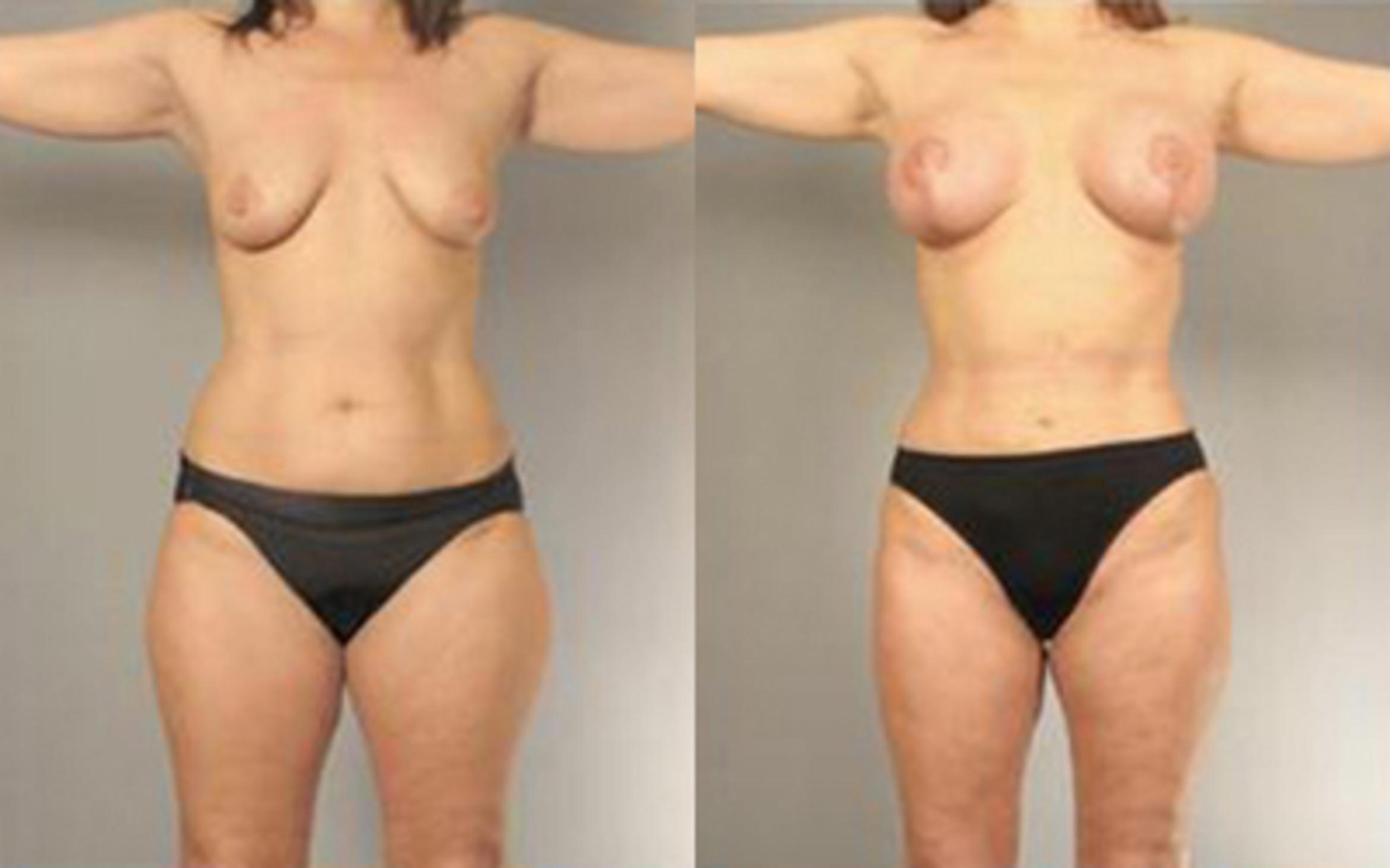 Before & After Liposuction Case 4093 View 1 View in Houston, TX