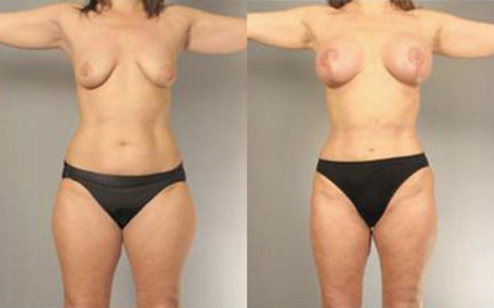 Before & After Liposuction Case 4093 View 1 View in Houston, TX