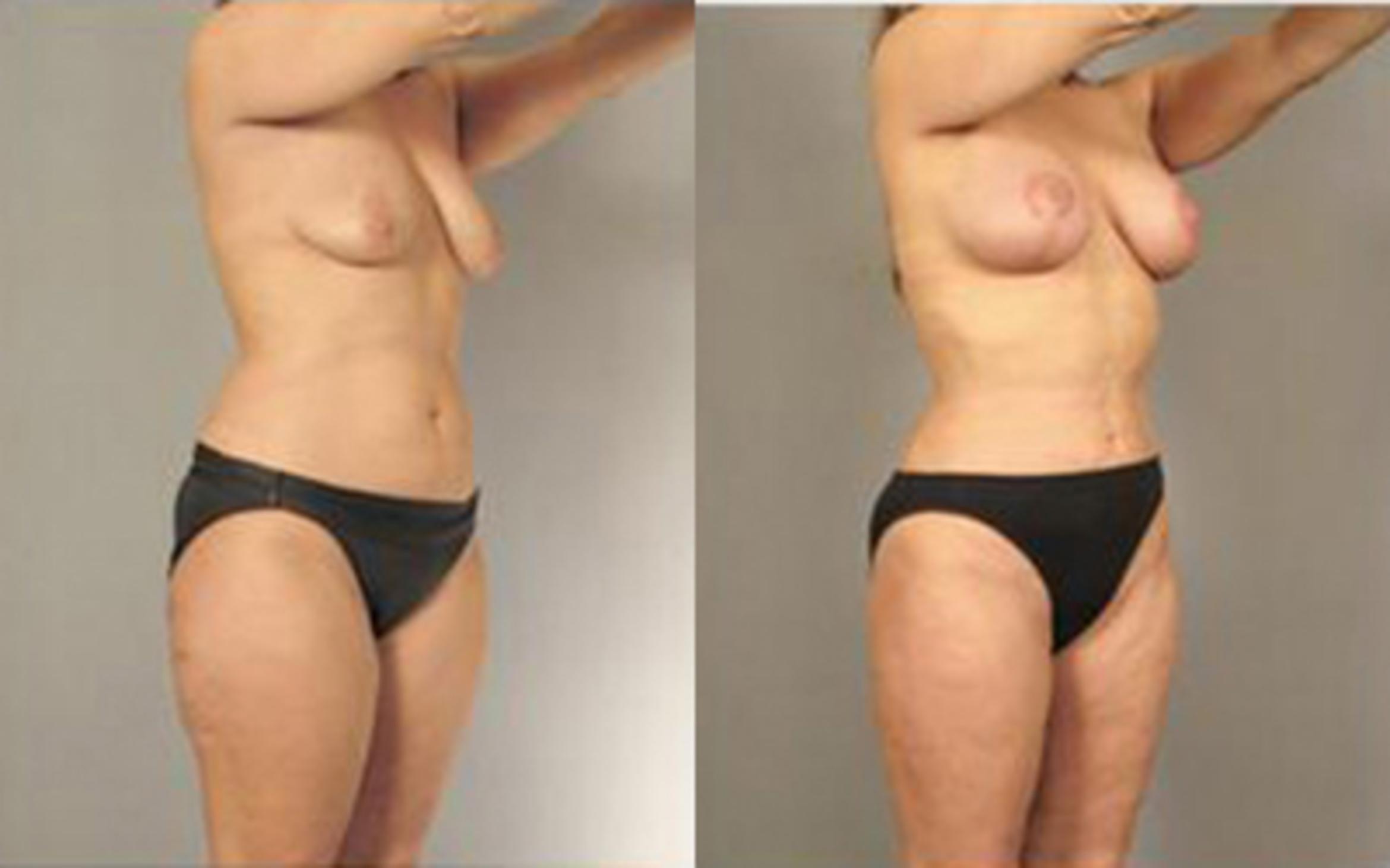 Before & After Liposuction Case 4093 View 2 View in Houston, TX