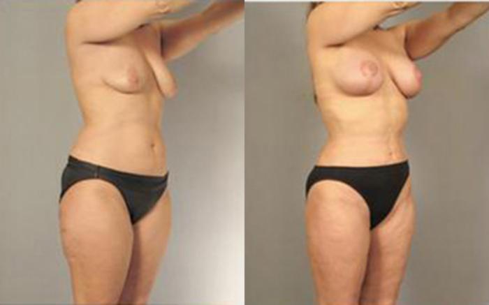 Before & After Liposuction Case 4093 View 2 View in Houston, TX