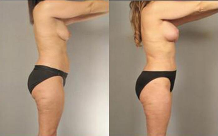 Before & After Liposuction Case 4093 View 3 View in Houston, TX