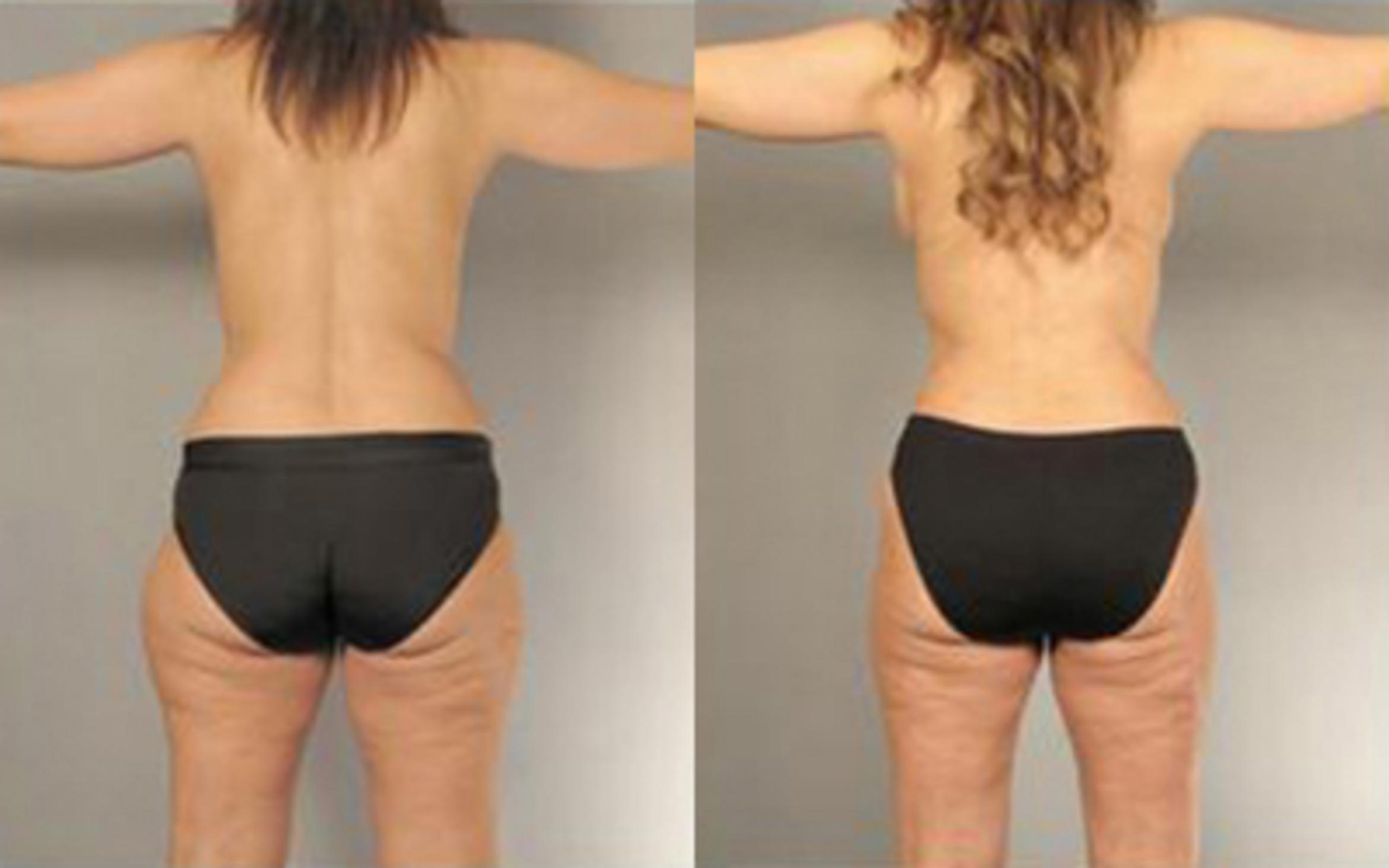 Before & After Liposuction Case 4093 View 4 View in Houston, TX