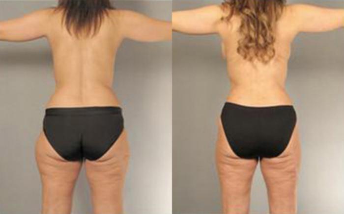 Before & After Liposuction Case 4093 View 4 View in Houston, TX