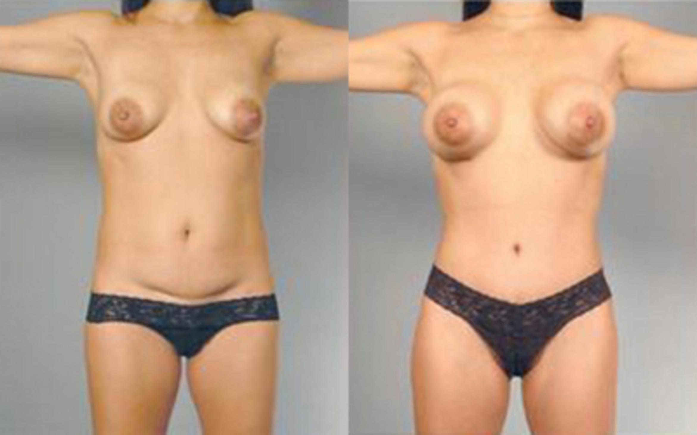 Before & After Liposuction Case 4103 View 1 View in Houston, TX