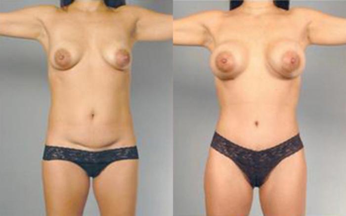 Before & After Liposuction Case 4103 View 1 View in Houston, TX