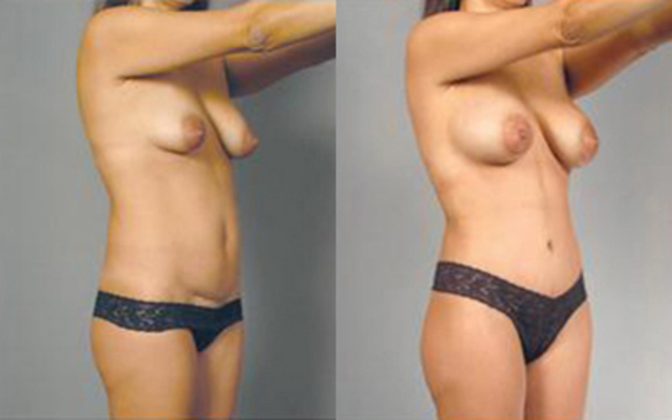 Before & After Liposuction Case 4103 View 2 View in Houston, TX
