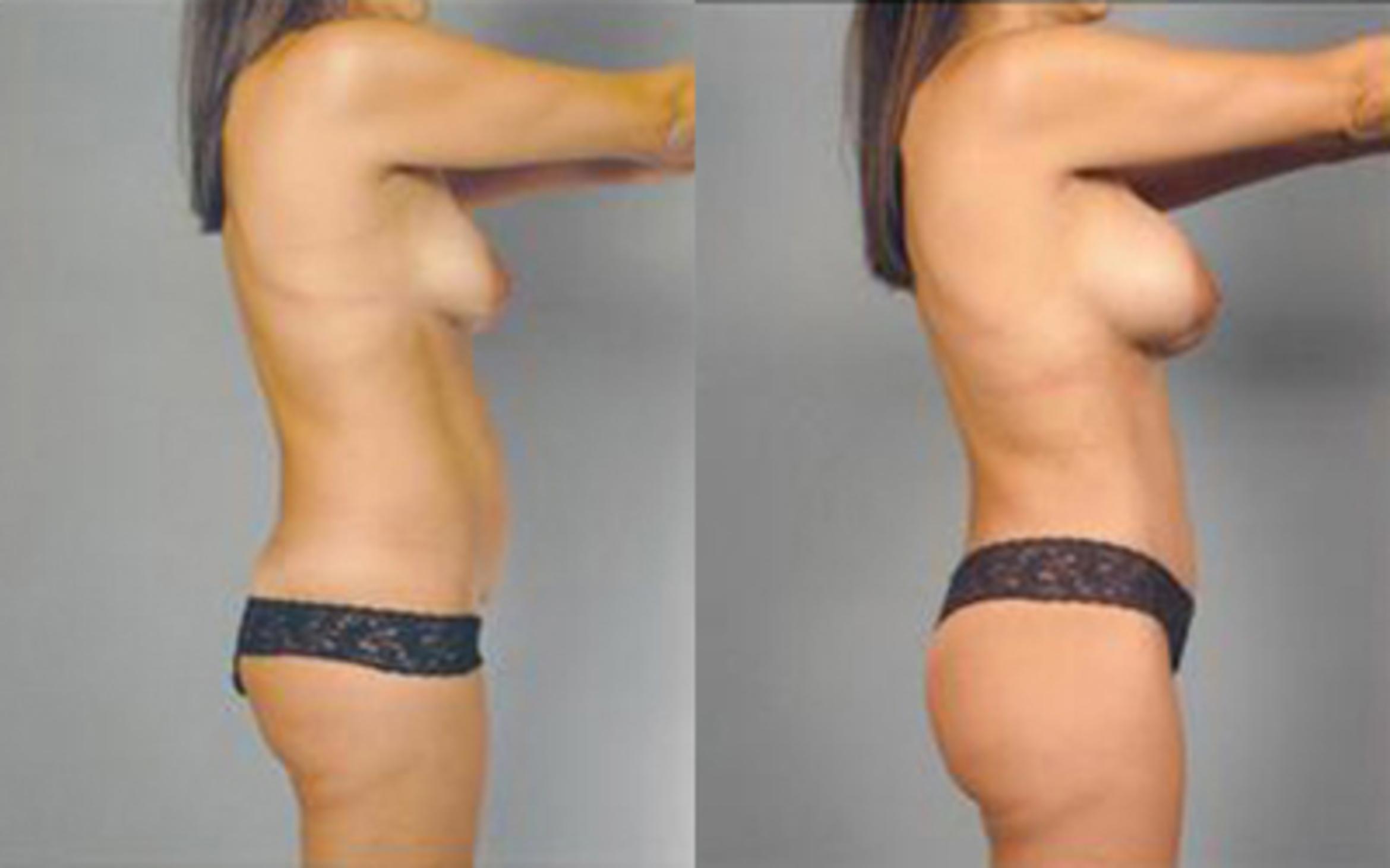 Before & After Liposuction Case 4103 View 3 View in Houston, TX