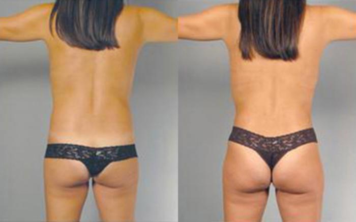 Before & After Liposuction Case 4103 View 4 View in Houston, TX