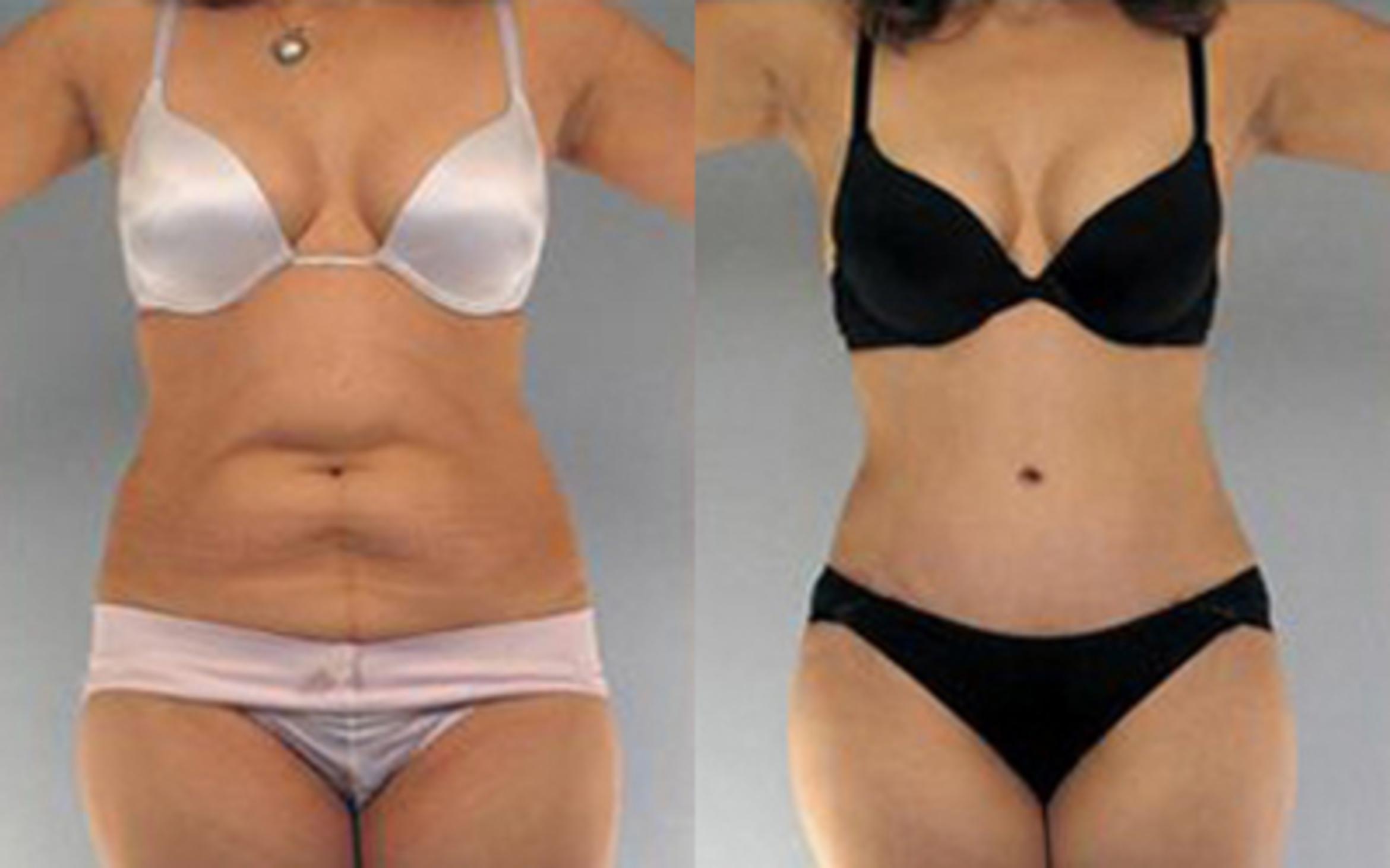 Before & After Liposuction Case 4113 View 1 View in Houston, TX