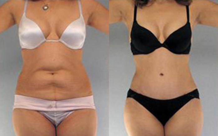 Before & After Liposuction Case 4113 View 1 View in Houston, TX