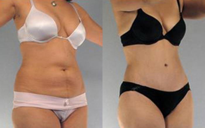 Before & After Liposuction Case 4113 View 2 View in Houston, TX