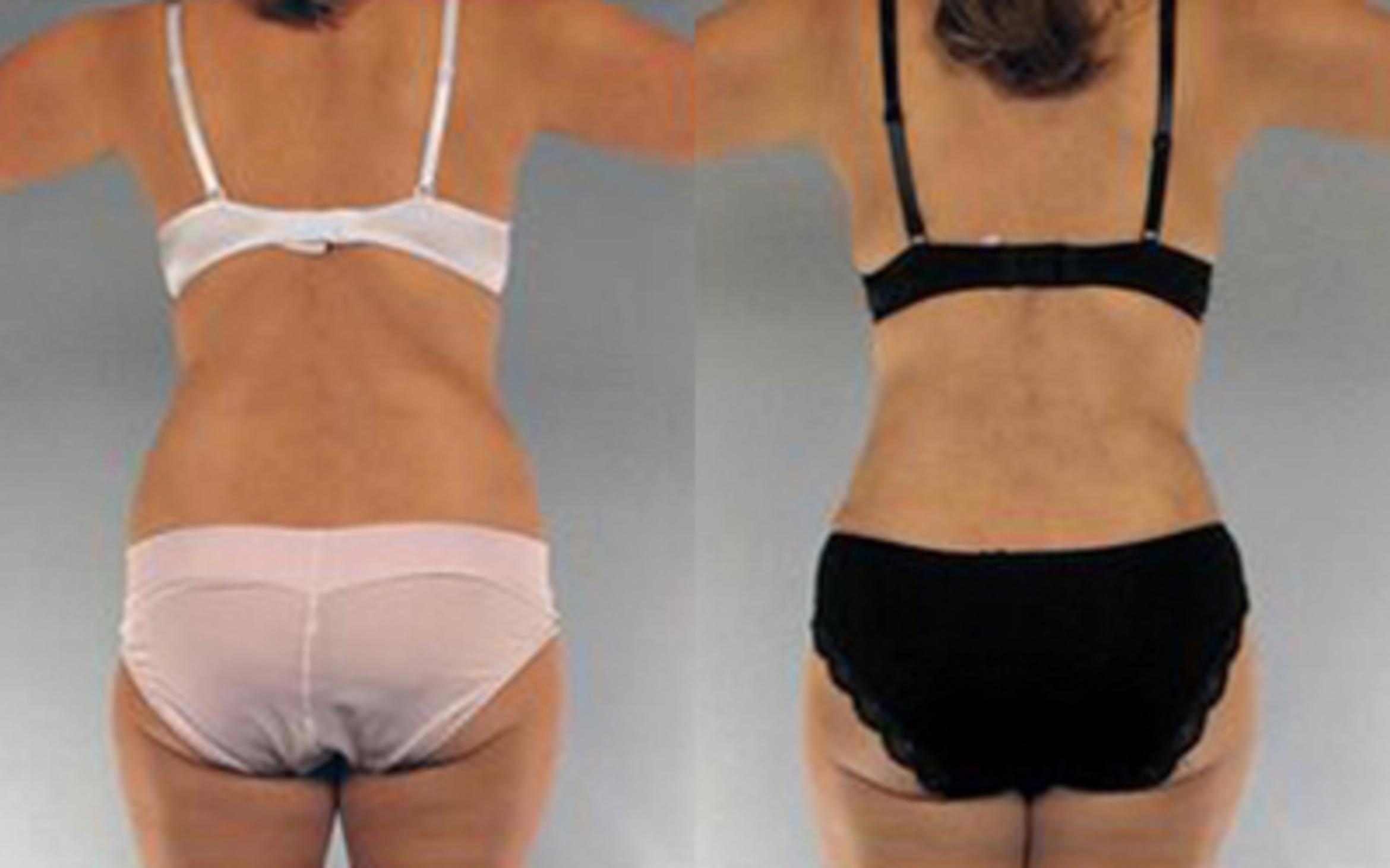 Before & After Liposuction Case 4113 View 4 View in Houston, TX