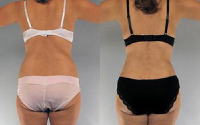 Before & After Liposuction Case 4113 View 4 View in Houston, TX