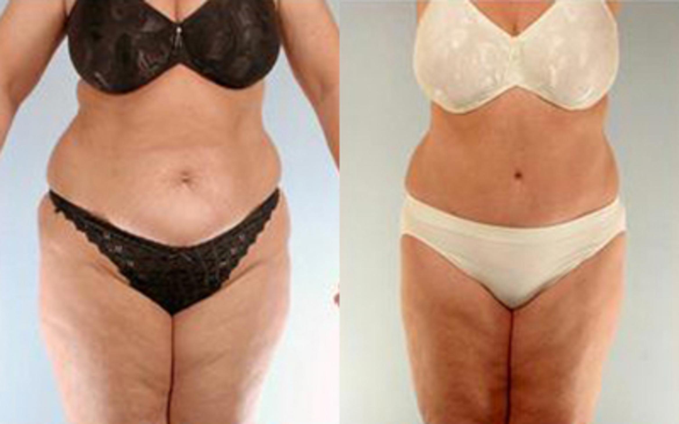Before & After Liposuction Case 4123 View 1 View in Houston, TX