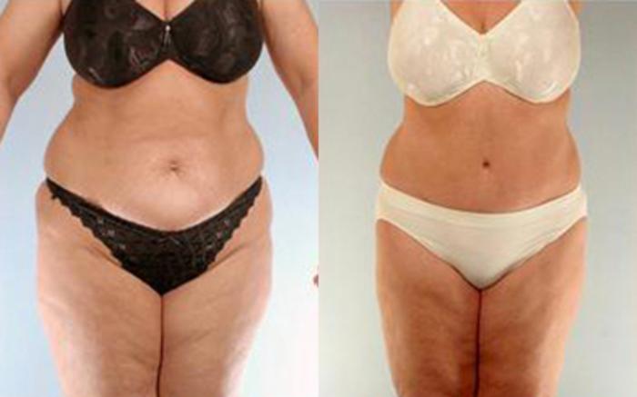 Before & After Liposuction Case 4123 View 1 View in Houston, TX