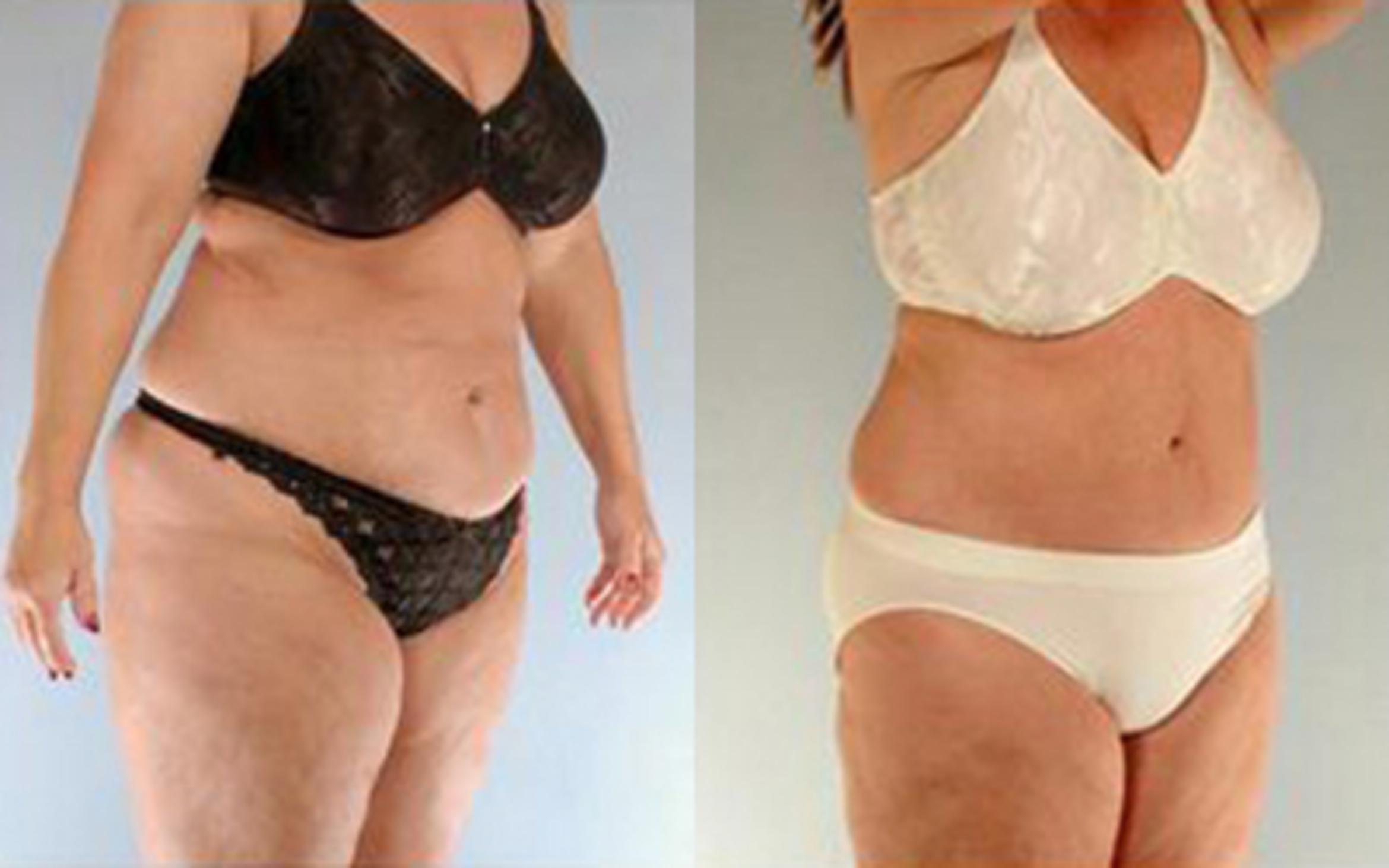 Before & After Liposuction Case 4123 View 2 View in Houston, TX