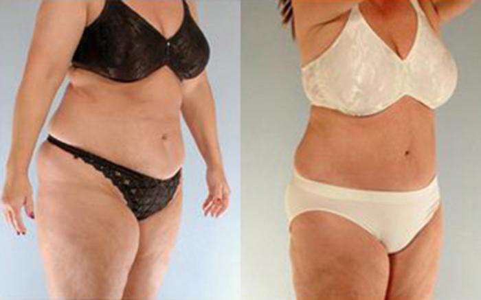 Before & After Liposuction Case 4123 View 2 View in Houston, TX