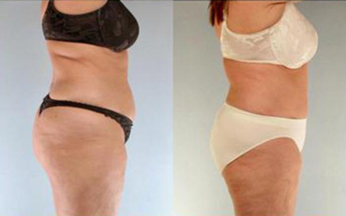 Before & After Liposuction Case 4123 View 3 View in Houston, TX