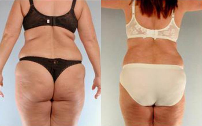 Before & After Liposuction Case 4123 View 4 View in Houston, TX