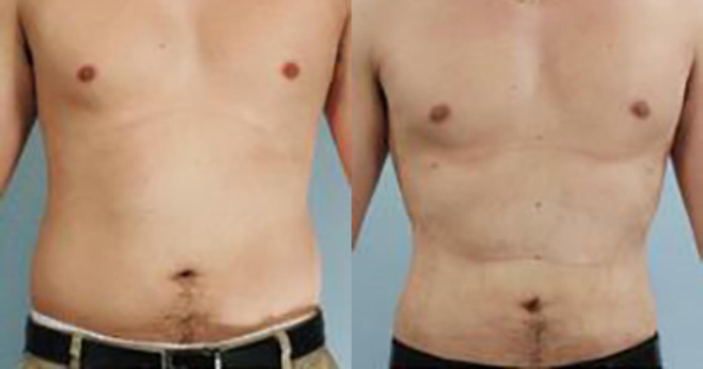 Before & After Liposuction Case 5275 View 1 View in Houston, TX