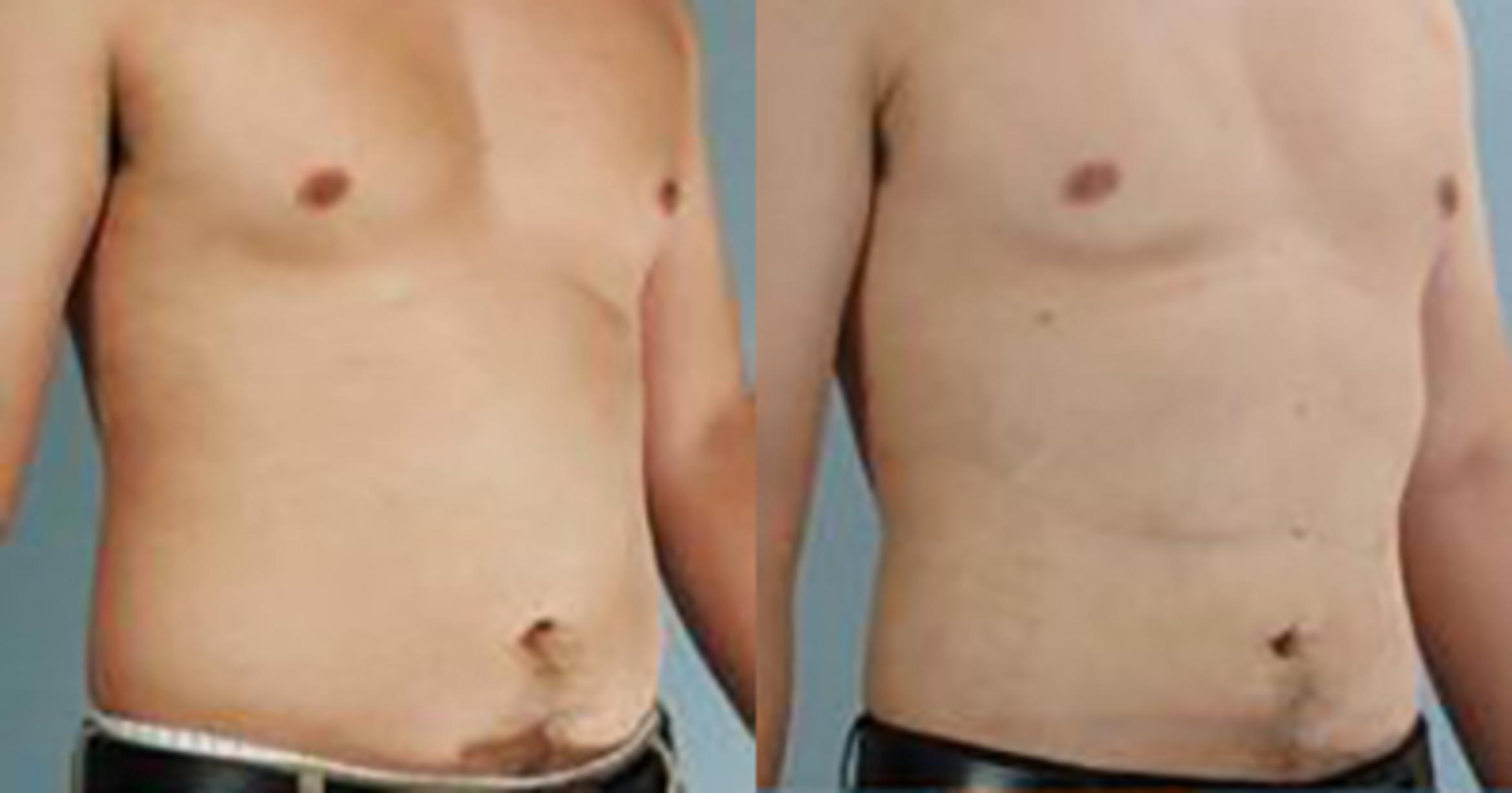 Before & After Liposuction Case 5275 View 2 View in Houston, TX
