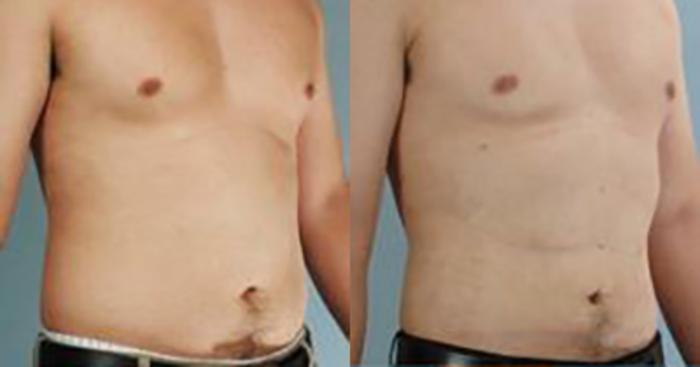 Before & After Liposuction Case 5275 View 2 View in Houston, TX