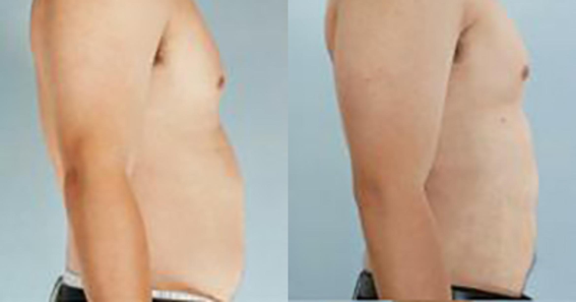 Before & After Liposuction Case 5275 View 3 View in Houston, TX
