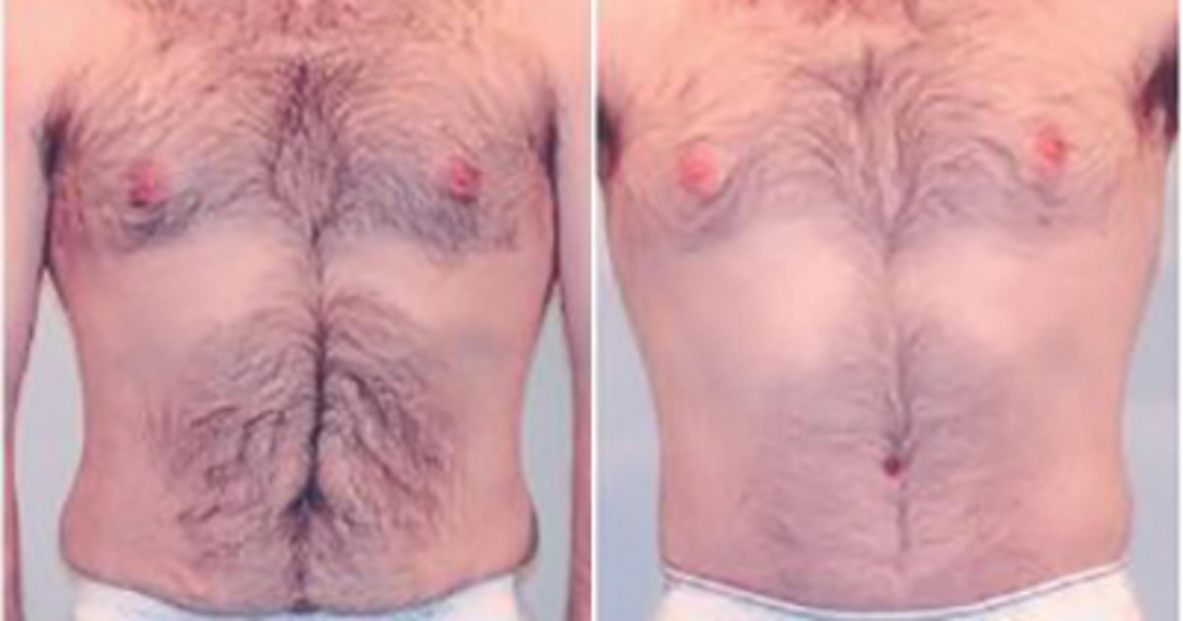 Before & After Liposuction Case 5285 View 1 View in Houston, TX