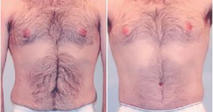 Before & After Liposuction Case 5285 View 1 View in Houston, TX