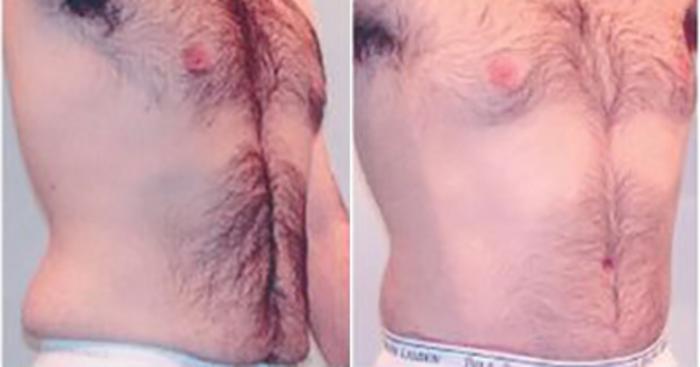 Before & After Liposuction Case 5285 View 2 View in Houston, TX