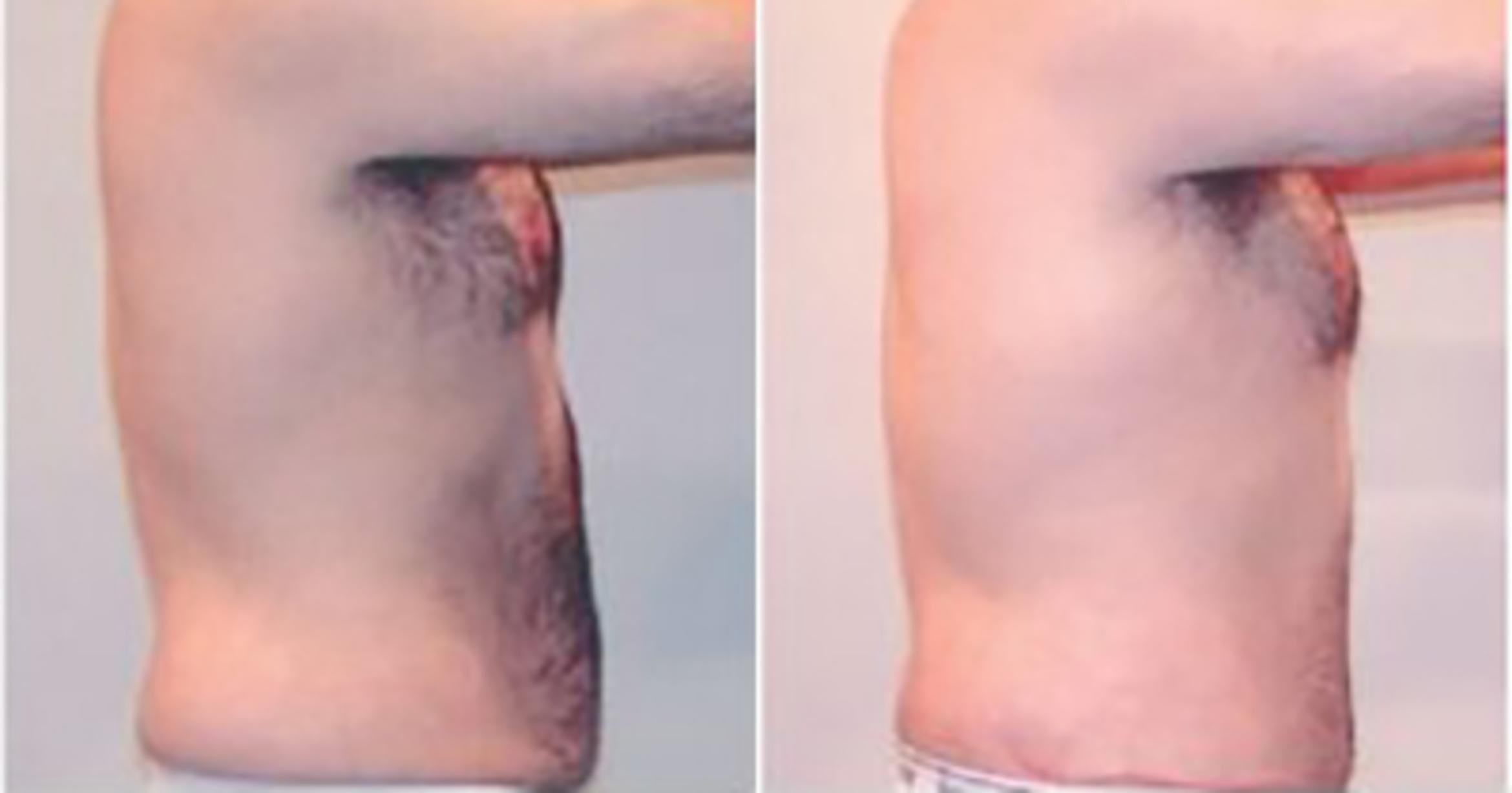 Before & After Liposuction Case 5285 View 3 View in Houston, TX