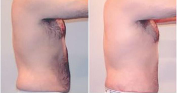 Before & After Liposuction Case 5285 View 3 View in Houston, TX