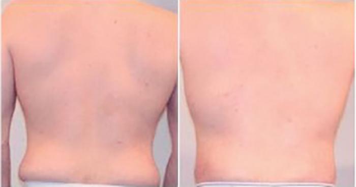 Before & After Liposuction Case 5285 View 4 View in Houston, TX