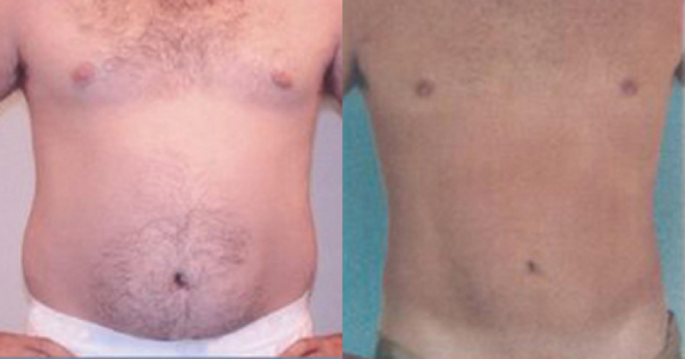 Before & After Liposuction Case 5295 View 1 View in Houston, TX