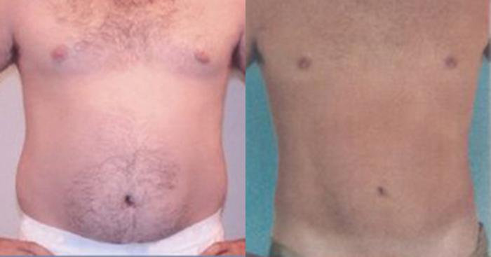 Before & After Liposuction Case 5295 View 1 View in Houston, TX